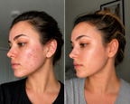 Sloom Skin | Pro LED Red Light Therapy Mask