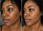 Sloom Skin | Pro LED Red Light Therapy Mask